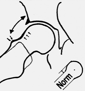 Abb. 1: Schema des Hüftgelenks rechts mit mechanischem Konflikt zwischen Pfannenrand des Beckens (dunkel dargestellt die Gelenklippe) und Schenkelhals des Oberschenkelknochens bei der Hüftbeugung.